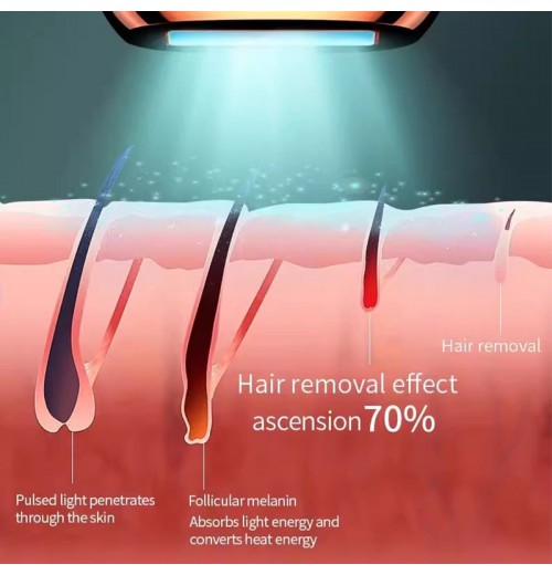 IPL-Laser-Haarentfernung IPL-Laser-Haarentfernung